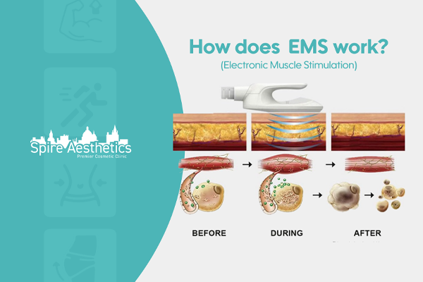 EMS treatment for post pregnancy weight loss treatment Henley In Arden