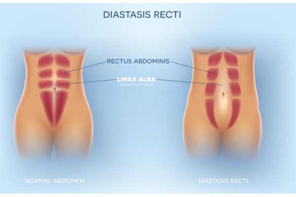 What Non-Surgical Options Are Available for Diastasis Recti Henley In Arden?