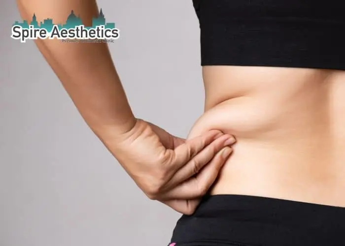 Image of woman pinching fat on their hips Henley In Arden. Fat Freezing treatment