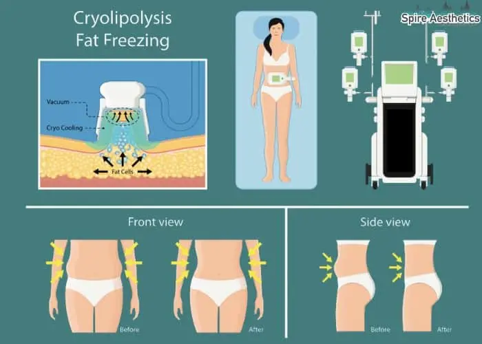 Fat freezing treatment Henley In Arden benefits for competitions to remove stubborn fat deposits.