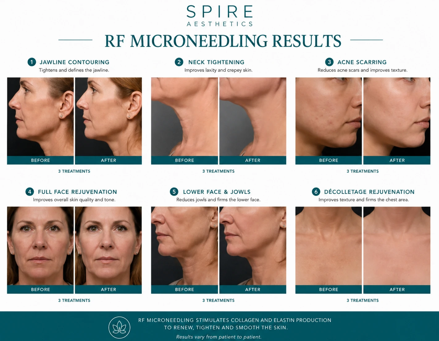 RF Microneedling Skin tightening Henley In Arden results