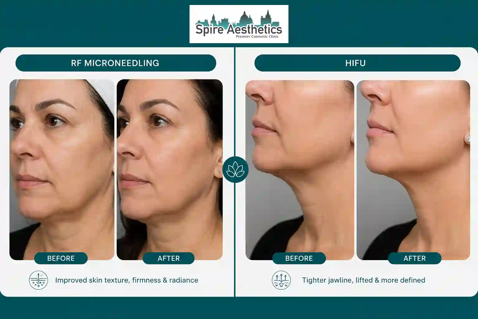 Can RF Microneedling and HIFU Be Combined Henley In Arden?