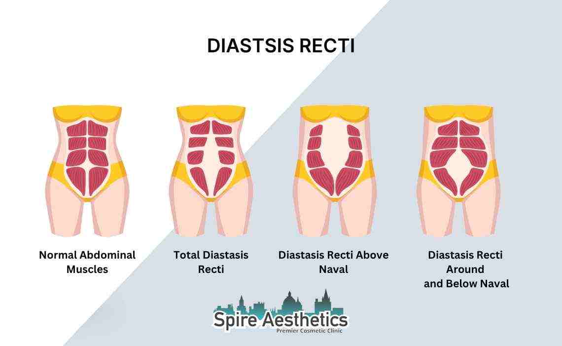 Is Non-Surgical Diastasis Recti Treatment Right for You? Common Concerns Answered Henley In Arden